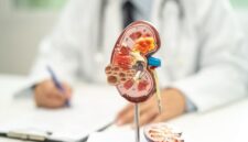 Ilustrasi menunjukkan organ ginjal dan area yang berpotensi mengalami kanker ginjal pada tubuh manusia